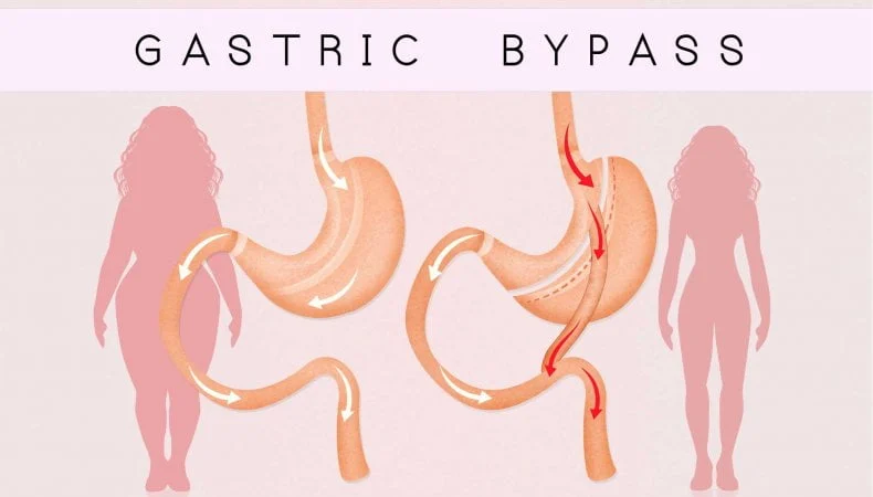 Gastric Bypass