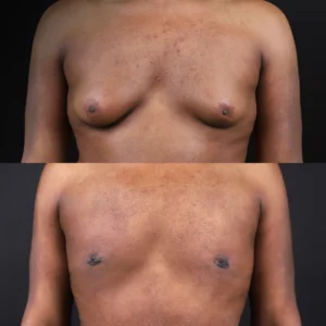 Gynecomastia