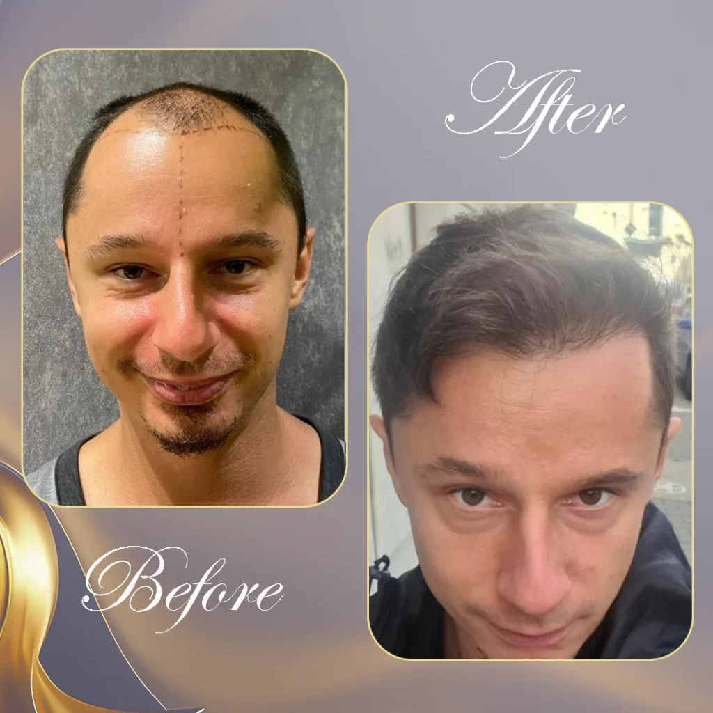 أفضل مشفى لزراعة الشعر