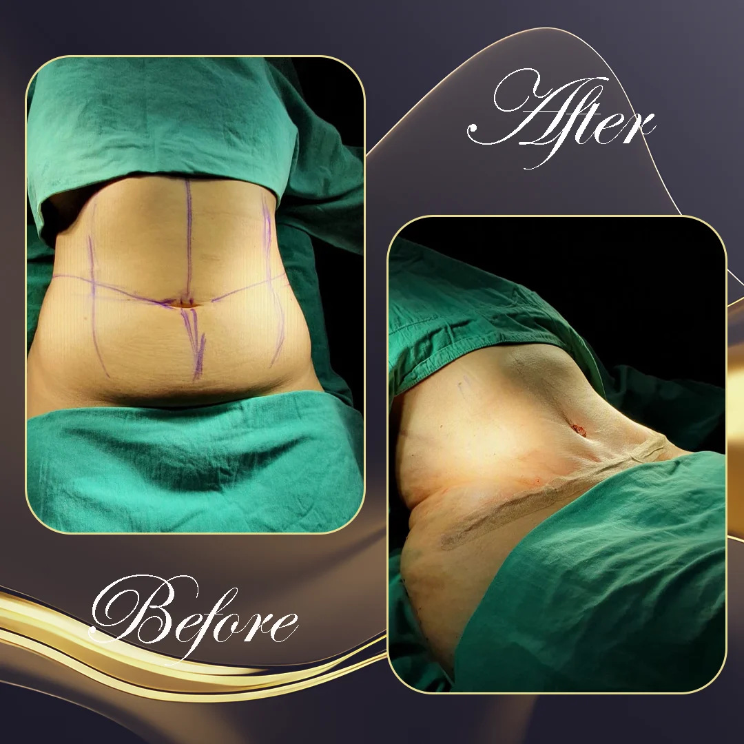 جراحة السمنة