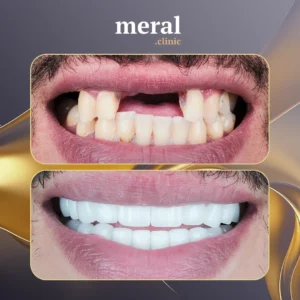  ile Alman Medigma Diş İmplantları